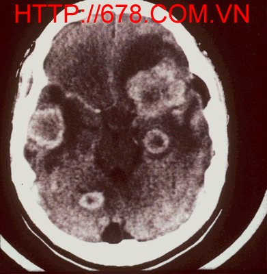 Bệnh lý Toxoplasma não